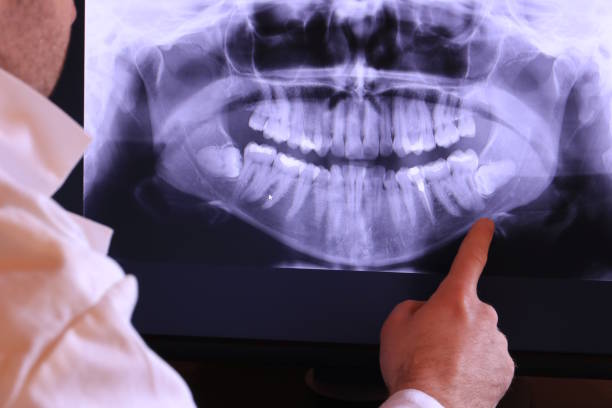 Best Emergency Wisdom Teeth Removal in Memphis, MI